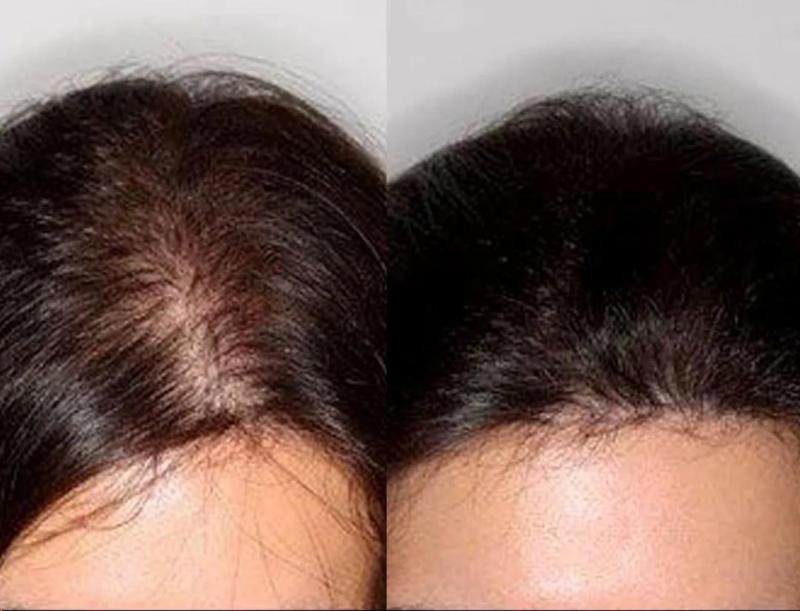 La solución discreta para la pérdida de cabello